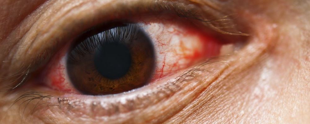 哪些 危害 及时 红眼病 症状 分泌 感染 引起 治疗 出血 淋巴 
