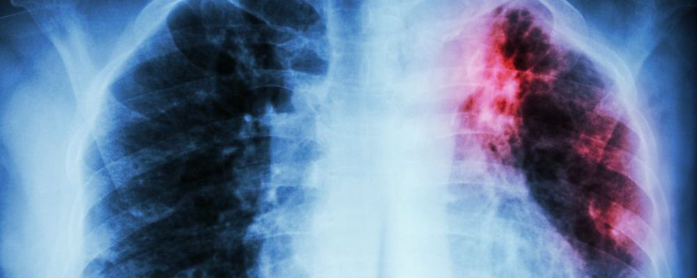 养肺的方法有哪些 患上肺癌有什么症状 患上肺癌会反复发烧吗