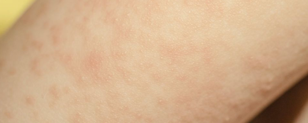 为什么会得湿疹 湿疹的特点是什么 湿疹会传染吗