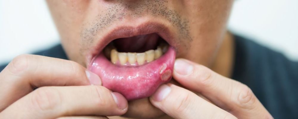 口腔溃疡反复发作是什么原因 口腔溃疡反复发作怎么办 口腔溃疡一直反复怎么办