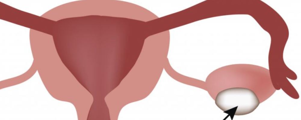 查出子宫肌瘤需要动手术吗 良性子宫肌瘤怎么办 子宫肌瘤怎么治疗