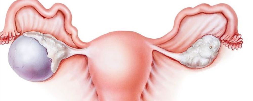 查出子宫肌瘤需要动手术吗 良性子宫肌瘤怎么办 子宫肌瘤怎么治疗